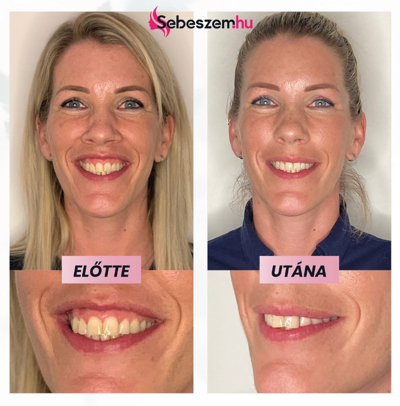 ínymosoly gummy smile kezelése