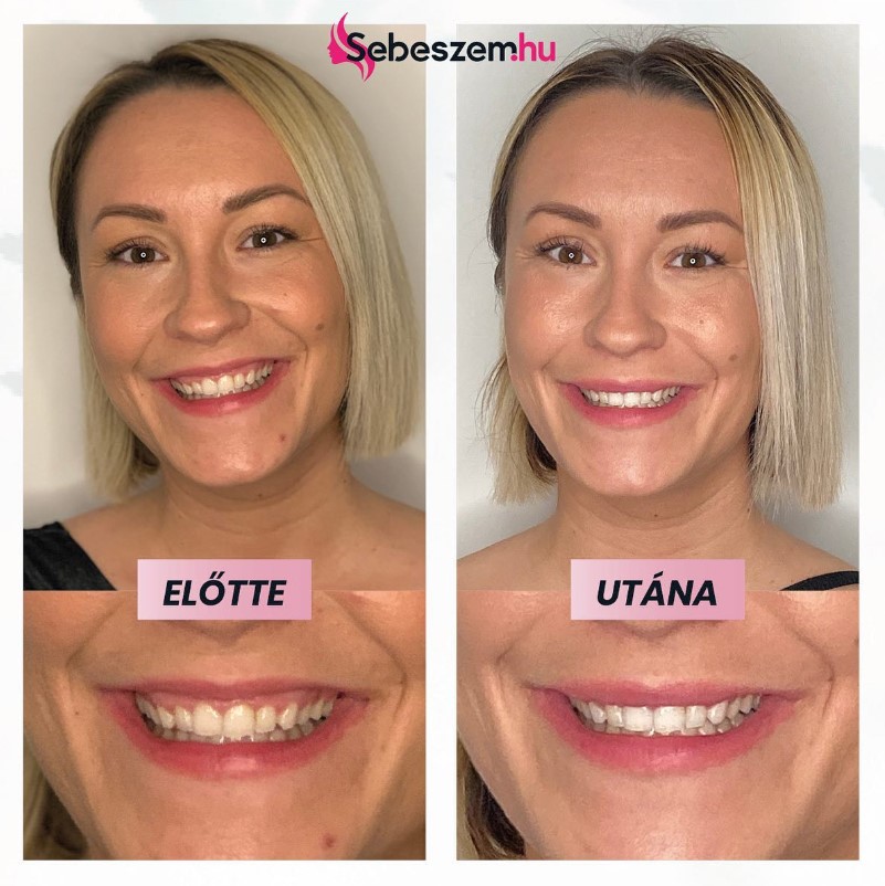 ínymosoly gummy smile kezelése